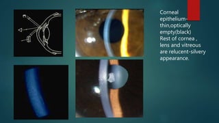 Corneal
epithelium-
thin,optically
empty(black)
Rest of cornea ,
lens and vitreous
are relucent-silvery
appearance.
 