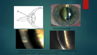 Optical section of lens
1.Corneal scar with wide beam illumination 2.optical section through scar
indicating scar is with in superficial layer of cornea.
 
