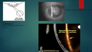 Schematic of
direct retroillumination from
the iris.
direct retroillumination from the iri
 