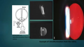 Schematic of
retroillumination from the
retina.
Example of retroillumination from the retina.
 
