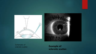 Schematic of
sclerotic scatter. Example of
sclerotic scatter.
 