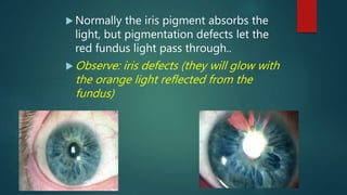  Normally the iris pigment absorbs the
light, but pigmentation defects let the
red fundus light pass through..
 Observe: iris defects (they will glow with
the orange light reflected from the
fundus)
 