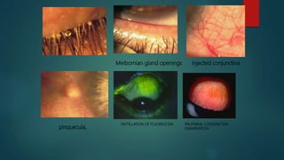 Injected conjunctivaMeibomian gland openings
pinquecula,
INSTILLATION OF FLUORESCEIN PALPEBRAL CONJUNCTIVA
EXAMINATION
 