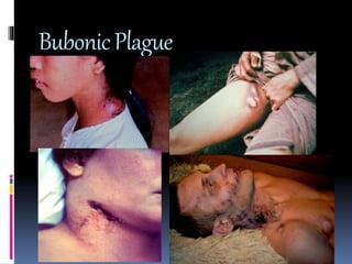Bubonic Plague 
 