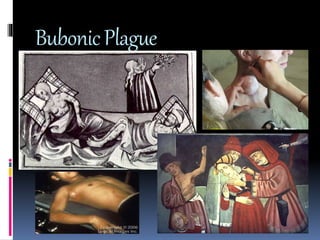 Bubonic Plague 
 