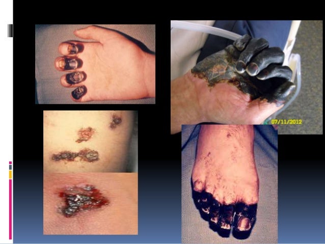 plague buboes pictures - DriverLayer Search Engine