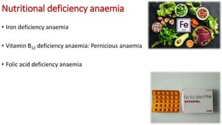 Nutritional deficiency anaemia
• Iron deficiency anaemia
• Vitamin B12 deficiency anaemia: Pernicious anaemia
• Folic acid deficiency anaemia
 