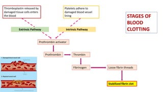 Thromboplastin released by
damaged tissue cells enters
the blood
Platelets adhere to
damaged blood vessel
lining
Prothrombin activator
Extrinsic Pathway
Prothrombin Thrombin
Fibrinogen Loose fibrin threads
Stabilized fibrin clot
Intrinsic Pathway
STAGES OF
BLOOD
CLOTTING
 