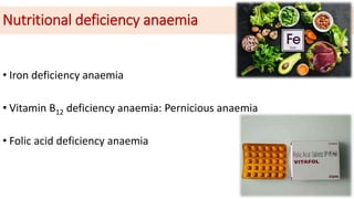 Nutritional deficiency anaemia
• Iron deficiency anaemia
• Vitamin B12 deficiency anaemia: Pernicious anaemia
• Folic acid deficiency anaemia
 