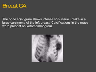 Breast CA The bone scintigram shows intense soft­ issue uptake in a large carcinoma of the left breast. Calcifications in the mass were present on xeromammogram. 