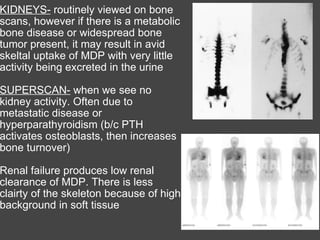 KIDNEYS-  routinely viewed on bone scans, however if there is a metabolic bone disease or widespread bone tumor present, it may result in avid skeltal uptake of MDP with very little activity being excreted in the urine   SUPERSCAN-  when we see no kidney activity. Often due to metastatic disease or hyperparathyroidism (b/c PTH activates osteoblasts, then increases bone turnover)   Renal failure produces low renal clearance of MDP. There is less clairty of the skeleton because of high background in soft tissue   