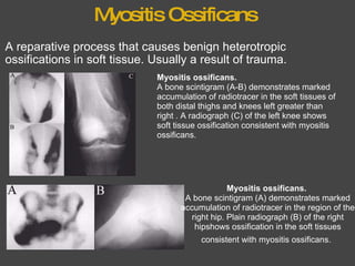 Myositis Ossificans A reparative process that causes benign heterotropic ossifications in soft tissue. Usually a result of trauma.      Myositis ossificans.   A bone scintigram (A-B) demonstrates marked accumulation of radiotracer in the soft tissues of both distal thighs and knees left greater than right . A radiograph (C) of the left knee shows soft tissue ossification consistent with myositis ossificans. Myositis ossificans.   A bone scintigram (A) demonstrates marked accumulation of radiotracer in the region of the right hip. Plain radiograph (B) of the right hipshows ossification in the soft tissues consistent with myositis ossificans.   