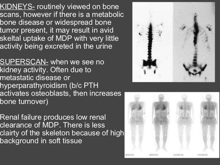 The Bone Scan
