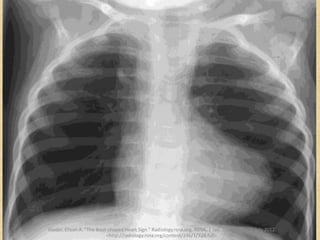 Haider, Ehsan A. "The Boot-shaped Heart Sign." Radiology.rsna.org. RSNA, 1 Jan. 2008. Web. 23 July 2012.
<http://radiology.rsna.org/content/246/1/328.full>.
Haider, Ehsan A. "The Boot-shaped Heart Sign." Radiology.rsna.org. RSNA, 1 Jan. 2008. Web. 23 July 2012.
<http://radiology.rsna.org/content/246/1/328.full>.
 