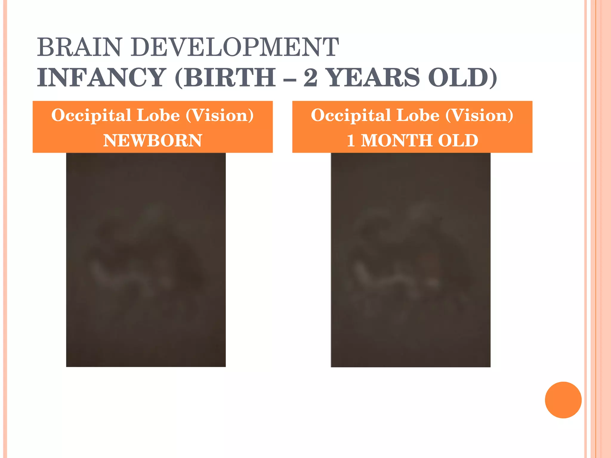 BRAIN DEVELOPMENT INFANCY (BIRTH – 2 YEARS OLD) Occipital Lobe (Vision) NEWBORN Occipital Lobe (Vision) 1 MONTH OLD 