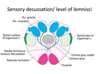 Sensory decussation/ level of lemnisci
 