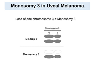 Monosomy 3 in Uveal Melanoma
Loss of one chromosome 3 = Monosomy 3
Disomy 3
Monosomy 3
Chromosome 3
pq
 