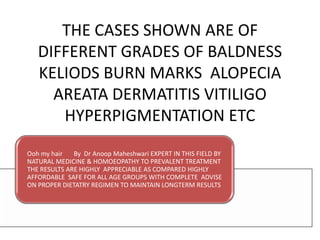 THE CASES SHOWN ARE OF
   DIFFERENT GRADES OF BALDNESS
   KELIODS BURN MARKS ALOPECIA
     AREATA DERMATITIS VITILIGO
      HYPERPIGMENTATION ETC
Ooh my hair   By Dr Anoop Maheshwari EXPERT IN THIS FIELD BY
NATURAL MEDICINE & HOMOEOPATHY TO PREVALENT TREATMENT
THE RESULTS ARE HIGHLY APPRECIABLE AS COMPARED HIGHLY
AFFORDABLE SAFE FOR ALL AGE GROUPS WITH COMPLETE ADVISE
ON PROPER DIETATRY REGIMEN TO MAINTAIN LONGTERM RESULTS
 