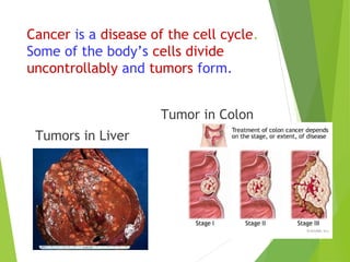 Cancer is a disease of the cell cycle. 
Some of the body’s cells divide 
uncontrollably and tumors form. 
Tumors in Liver 
Tumor in Colon 
 