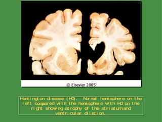 Huntington disease (HD).  Normal hemisphere on the left compared with the hemisphere with HD on the right showing atrophy of the striatum and ventricular dilation. 