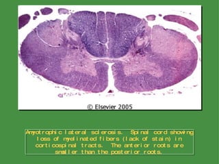 Amyotrophic lateral sclerosis.  Spinal cord showing loss of myelinated fibers (lack of stain) in corticospinal tracts.  The anterior roots are smaller than the posterior roots. 