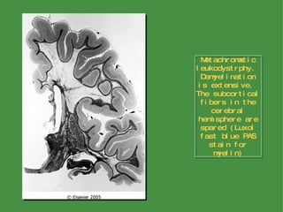 Metachromatic leukodystrphy.  Demyelination is extensive.  The subcortical fibers in the cerebral hemisphere are spared (Luxol fast blue PAS stain for myelin) 