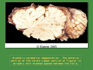 Alcoholic cerebellar degeneration.  The anterior portion of the vermis (upper portion of figure) is atrophic with widened spaces between the folia. 