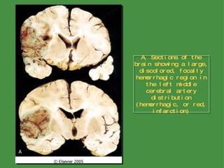 A, Sections of the brain showing a large, discolored, focally hemorrhagic region in the left middle cerebral artery distribution (hemorrhagic, or red, infarction) 
