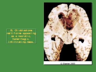 B, Glioblastoma multiforme appearing as a necrotic, hemorrhagic, infiltrating mass. 