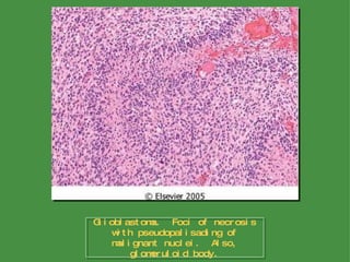 Glioblastoma.  Foci of necrosis with pseudopalisading of malignant nuclei.  Also, glomeruloid body. 