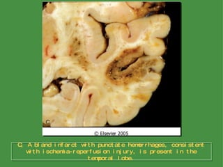 C, A bland infarct with punctate hemorrhages, consistent with ischemia-reperfusion injury, is present in the temporal lobe. 