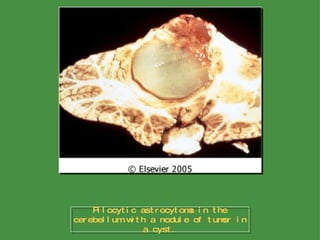 Pilocytic astrocytoma in the cerebellum with a nodule of tumor in a cyst. 