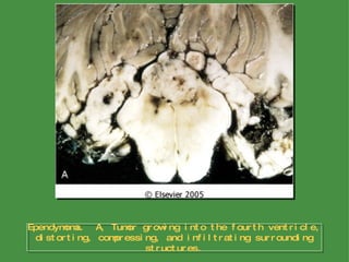 Ependymoma.  A, Tumor growing into the fourth ventricle, distorting, compressing, and infiltrating surrounding structures. 