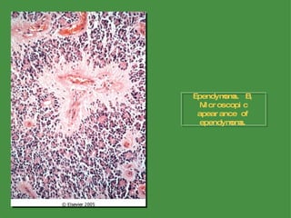 Ependymoma. B, Microscopic apearance of ependymoma. 
