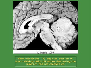Medulloblastoma.  B, Sagittal section of brain showing medulloblastoma destroying the superior midline cerebellum. 