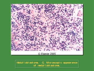 Medulloblastoma.  C, Microscopic appearance of medulloblastoma. 