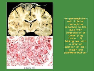 A, parasagittal multilobular meningioma attached to the dura with compression of underlying brain.  B, Meningioma with a whorled pattern of cell growth and psammoma bodies. 