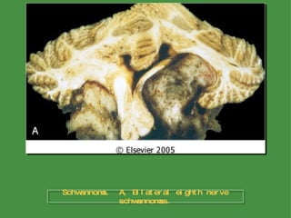 Schwannoma.  A, Bilateral eighth nerve schwannomas. 