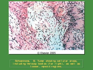 Schwannoma.  B, Tumor showing cellular areas, including Verocay bodies (far right), as well as looser, myxoid regions. 