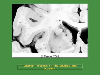 Lacunar infarcts in the caudate and putamen. 