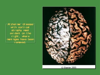 Alzheimer disease with cortical atrophy most evident on the right, where meninges have been removed. 