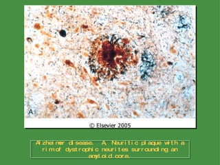 Alzheimer disease.  A, Neuritic plaque with a rim of dystrophic neurites surrounding an amyloid core. 
