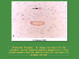 Alzheimer Disease.  B, Congo red stain of the cerebral cortex showing amyloid deposition in the blood vessels and the amyloid core of the neuritic plaque (arrow) 