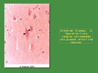 Alzheimer Disease.  C, Neurofibrillary tangles (arrowheads) are present within the neurons. 