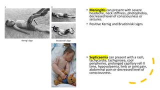 • Meningitis can present with severe
headache, neck stiffness, photophobia,
decreased level of consciousness or
seizures.
• Positive Kernig and Brudziniski signs
• Septicaemia can present with a rash,
tachycardia, tachypnoea, cool
peripheries, prolonged capillary refi ll
time, hypovolaemia, limb or joint pain,
abdominal pain or decreased level of
consciousness.
 