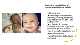 Long- term complications of
meningococcal disease include:
● Hearing loss
● Neurological impairment
including learning, motor and
neurodevelopment defi - cits
and epilepsy
● orthopaedic damage
including amputation, growth
plate damage and arthritis
● post- necrotic tissue/skin loss
● renal impairment
● psychiatric and behavioural
problems.
 