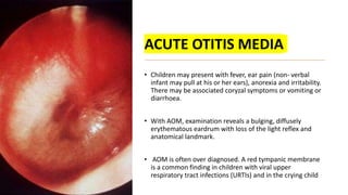 ACUTE OTITIS MEDIA
• Children may present with fever, ear pain (non- verbal
infant may pull at his or her ears), anorexia and irritability.
There may be associated coryzal symptoms or vomiting or
diarrhoea.
• With AOM, examination reveals a bulging, diffusely
erythematous eardrum with loss of the light reflex and
anatomical landmark.
• AOM is often over diagnosed. A red tympanic membrane
is a common finding in children with viral upper
respiratory tract infections (URTIs) and in the crying child
 
