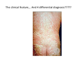 The clinical feature,.. And 4 differential diagnosis?????
 