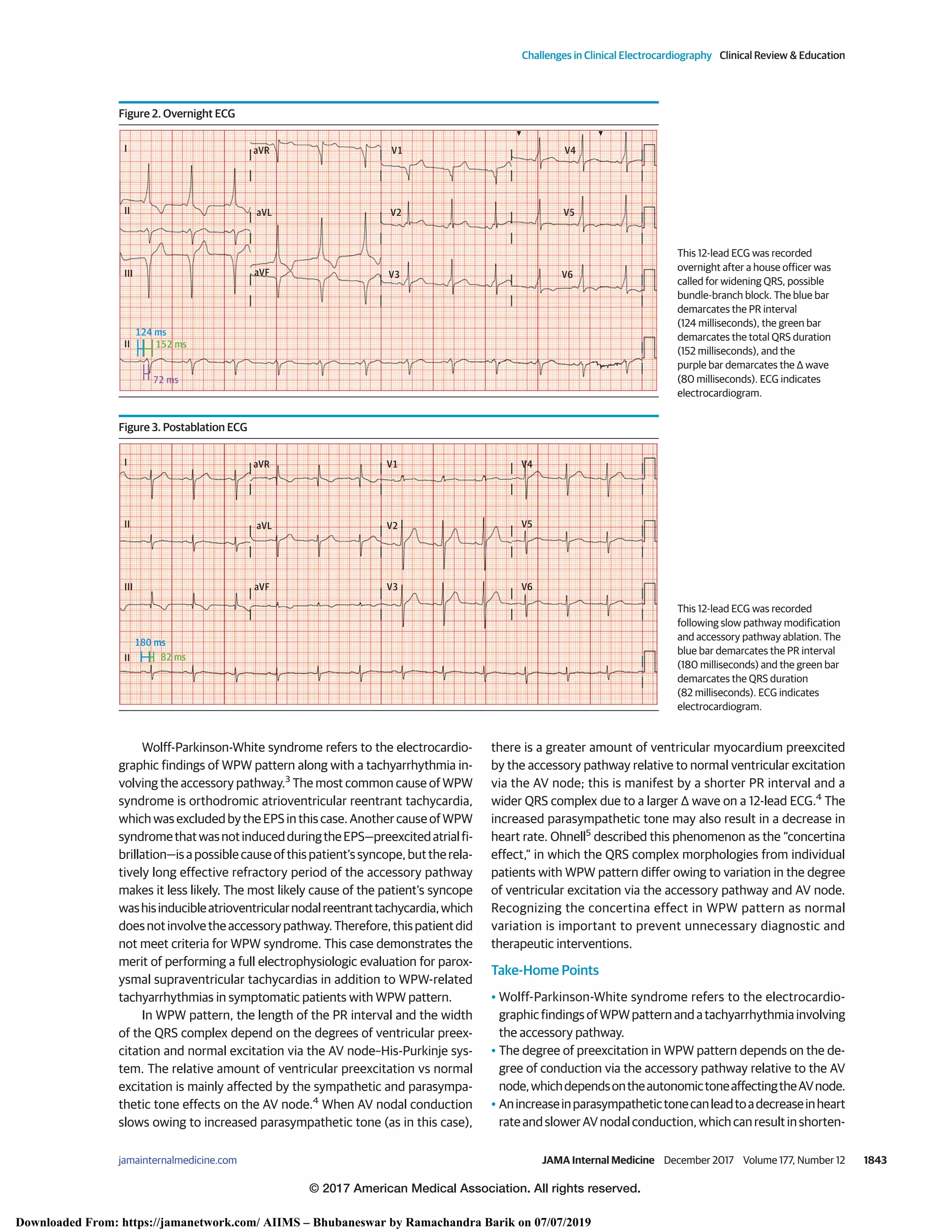 The concertina case of ventricular preexcitation | PDF