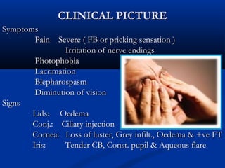 CLINICAL PICTURECLINICAL PICTURE
SymptomsSymptoms
Pain Severe ( FB or pricking sensation )Pain Severe ( FB or pricking sensation )
Irritation of nerve endingsIrritation of nerve endings
PhotophobiaPhotophobia
LacrimationLacrimation
BlepharospasmBlepharospasm
Diminution of visionDiminution of vision
SignsSigns
Lids: OedemaLids: Oedema
Conj.: Ciliary injectionConj.: Ciliary injection
Cornea: Loss of luster, Grey infilt., Oedema & +ve FTCornea: Loss of luster, Grey infilt., Oedema & +ve FT
Iris: Tender CB, Const. pupil & Aqueous flareIris: Tender CB, Const. pupil & Aqueous flare
 